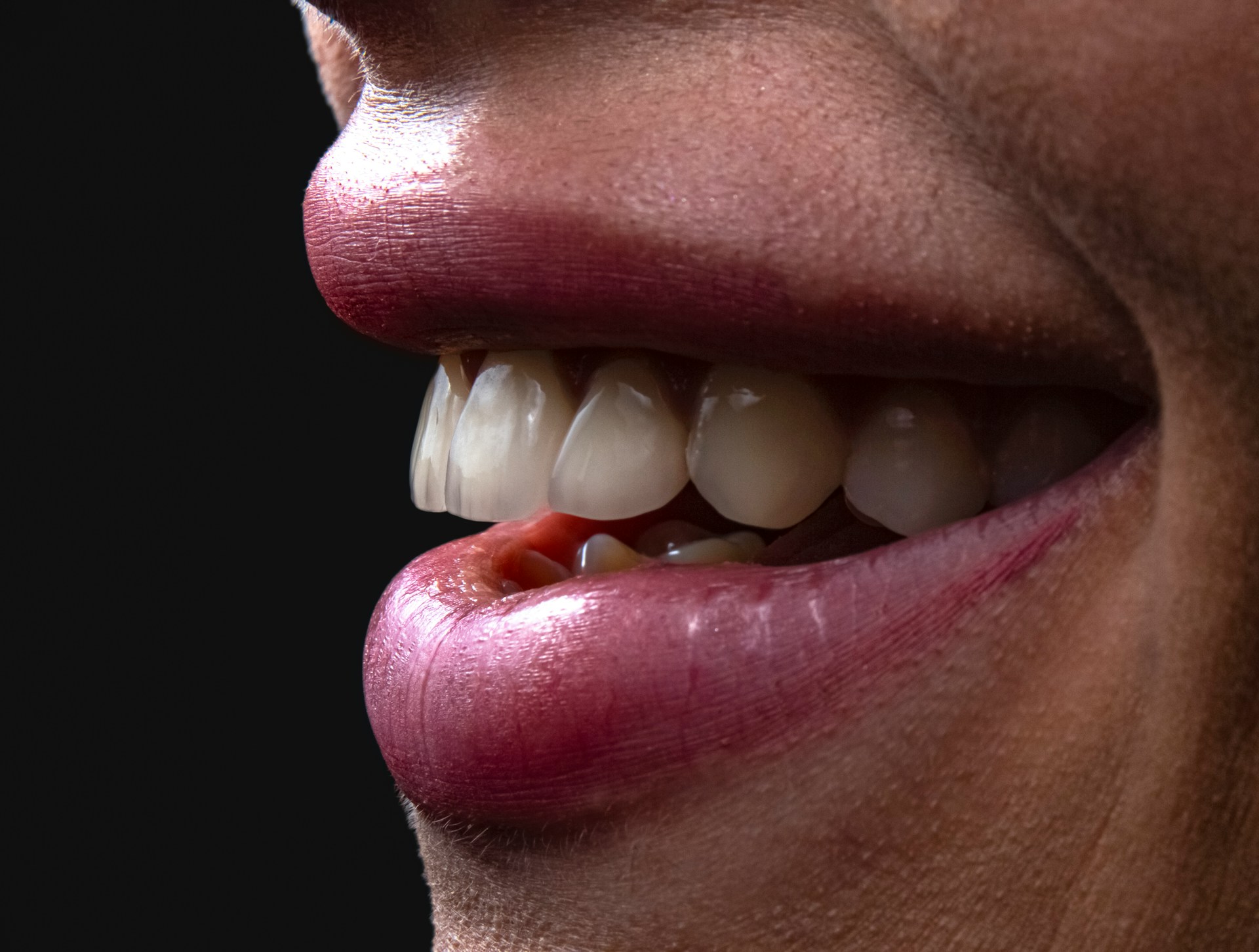 lipfillers Venlo